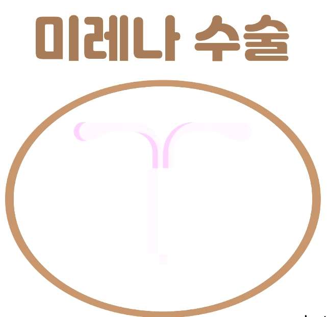 미레나 4년차 리얼 후기